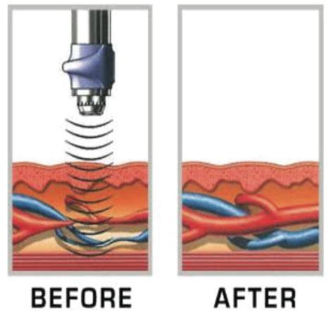 Acoustic Wave Therapy For Men