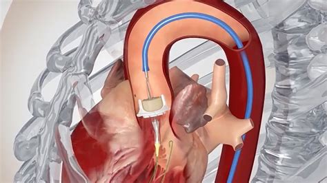 Aortic Valve Tavr Procedure