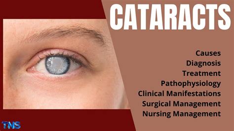 Are You At Risk For Cataracts Discover Risk Factors For One Of The Most Common Eye Conditions And The Leading Cause Of Blindness In The United States During Cataract Awareness Month Unthsc Https Bit Ly 2Z74zyt