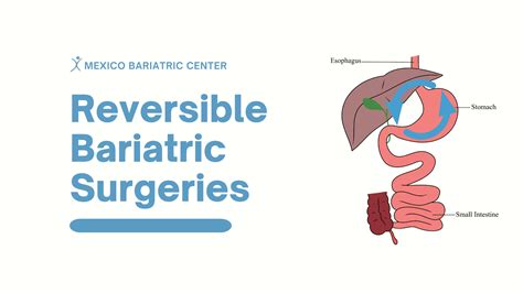 Bariatric Surgery Mexico A One Stop Guide