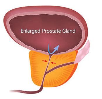 Benign Prostatic Hyperplasia Bph Johns Hopkins Medicine