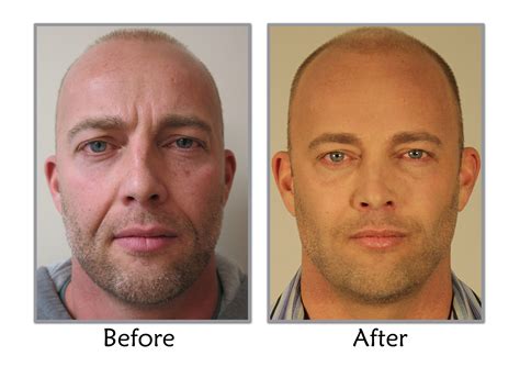 Best Plastic Surgery For Men