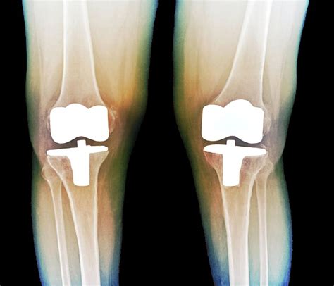 Bilateral Knee Replacement Facts Iytmed Com