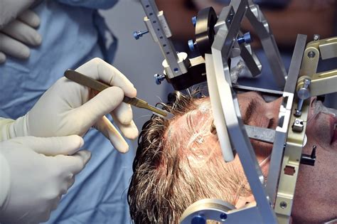 Brain Surgery For Depression