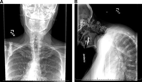 Calcium Deposits In Cervical Spine