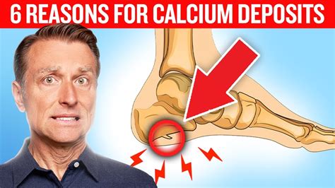 Calcium Deposits In Muscles