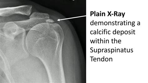 Calcium Deposits In Shoulders