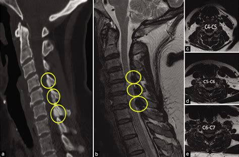 Calcium Deposits In Spinal Cord