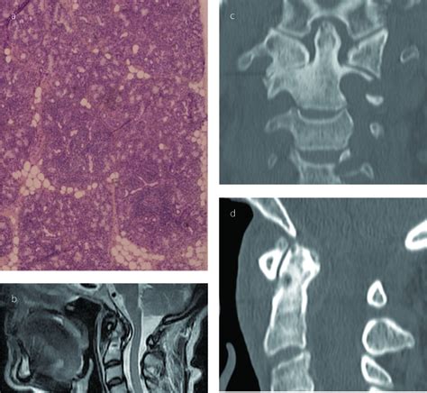 Calcium In Cervical Spinal Cord