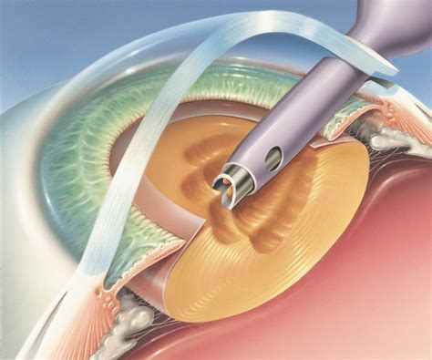 Cataract Surgery Midland Tx