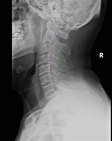 Cervical Xray Lateral Curve