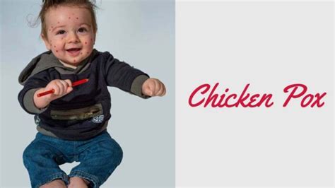 Chicken Pox Definition Symptoms Causes Risk Factors Diagnostic Test Treatment And