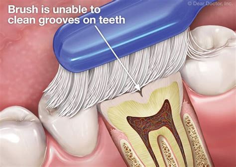 Cleaning Deep Grooves In Teeth