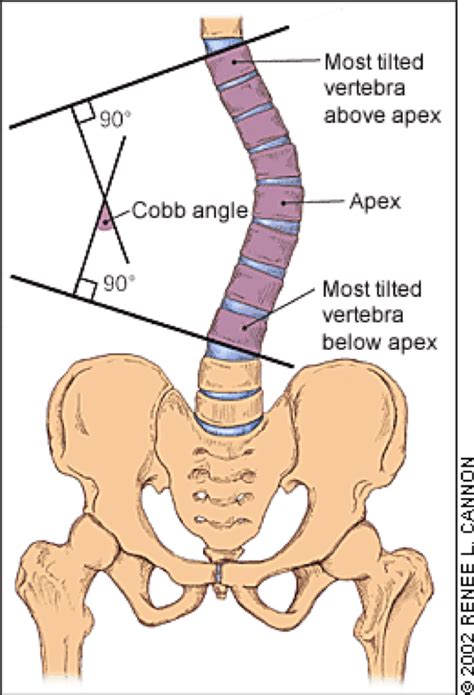 Cobb Angle Physiopedia