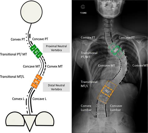 Concave Vs Convex Scoliosis