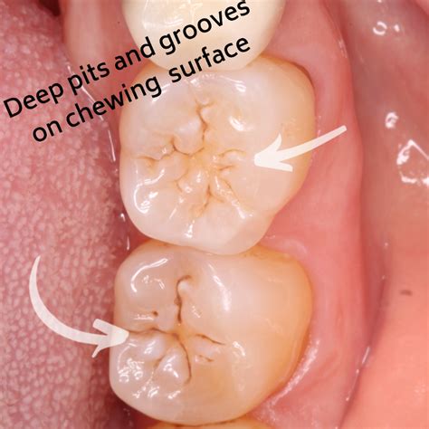 Deep Grooves In Front Teeth