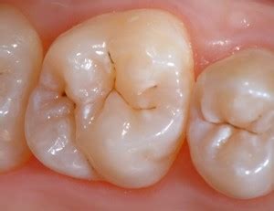 Deep Grooves In Teeth Treatment