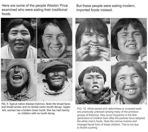 Dental Problems In Inuit Kids