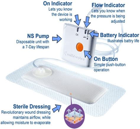 Disposable Wound Vac From Joerns