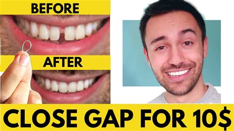 Diy Close Gap Teeth At Home My Update Youtube