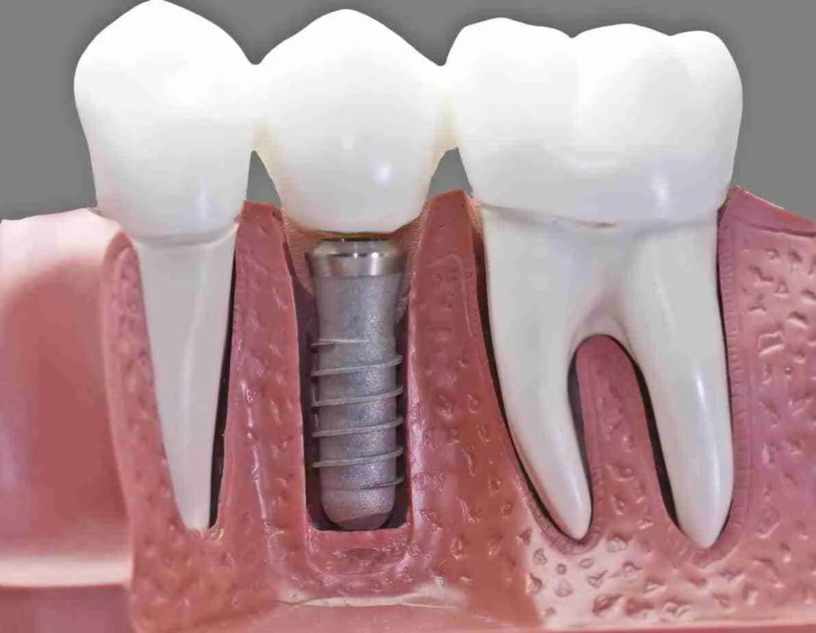 Does Emblemhealth Cover Dental Implants