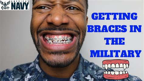 Military Pays for Braces Sometimes