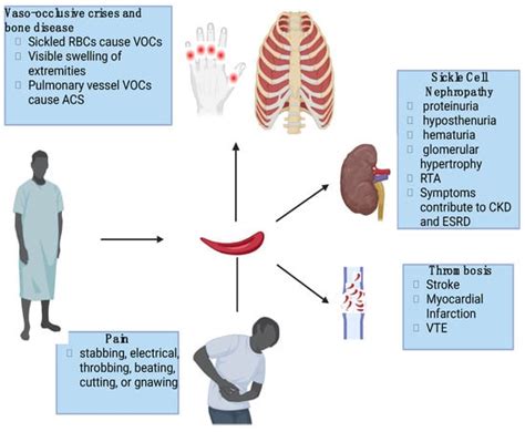 End Organ Affection In Sickle Cell Disease