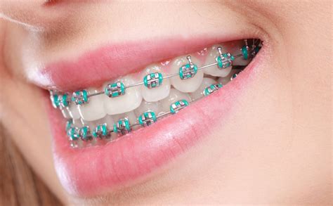 Free Orthodontic Braces For Adults