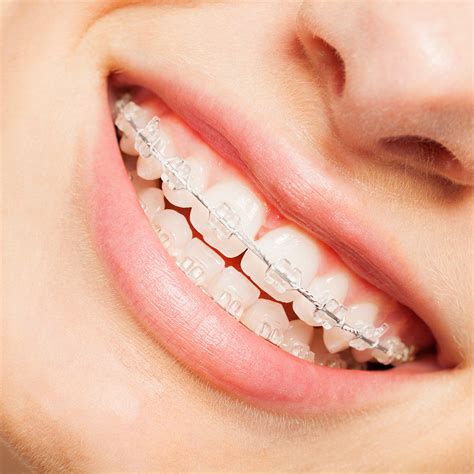 Free Orthodontic Braces For Seniors