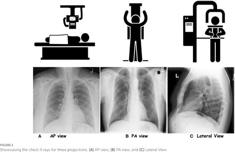 Frontiers Ai Based Radiodiagnosis Using Chest X Rays A Review