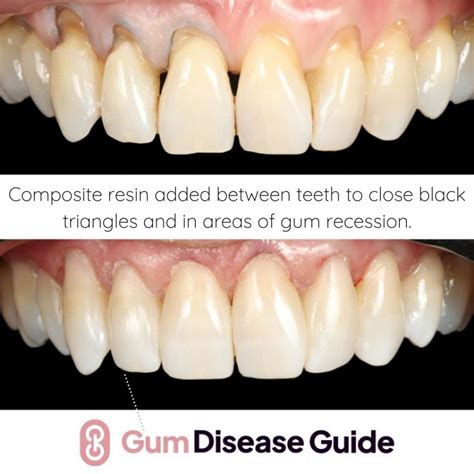 Gum Recession Treatment Without Grafting