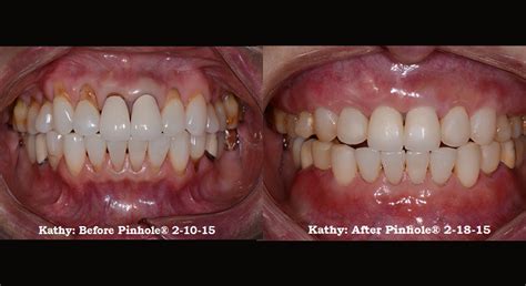 Gums Improvement In A Month