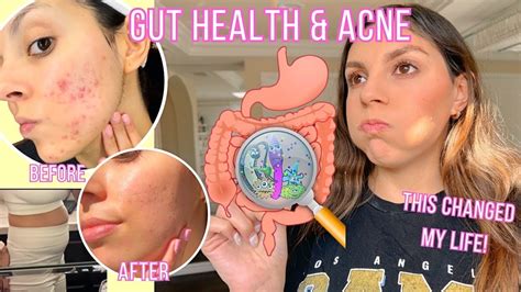 Gut Health Acne Reddit