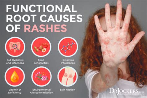 Gut Health And Skin Rashes