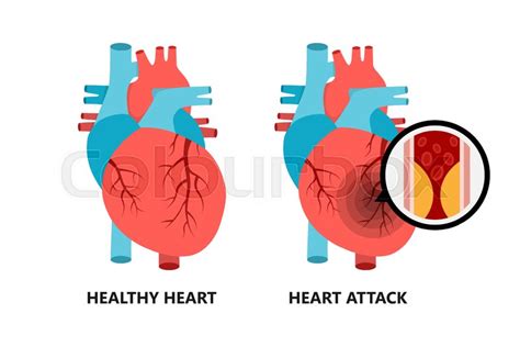 Healthy And Unhealthy Heart Drawing