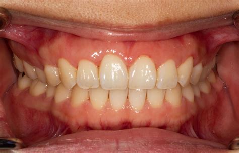 Healthy Gums Pictures