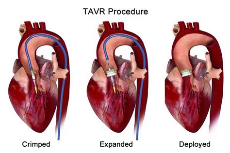 High Risk Tavr Procedure