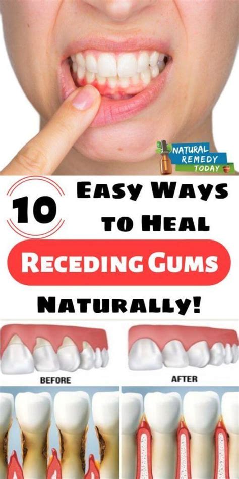 How To Improve Gum Recession