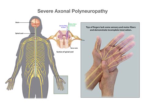 Idiopathic Axonal Neuropathy Prognosis