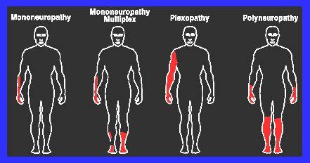 Idiopathic Progressive Neuropathy Vs Peripheral