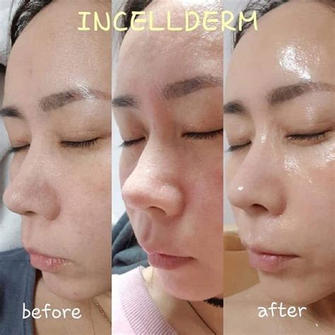 Incellderm Before And After