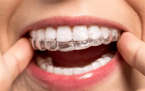 Invisalign Covered By Tricare