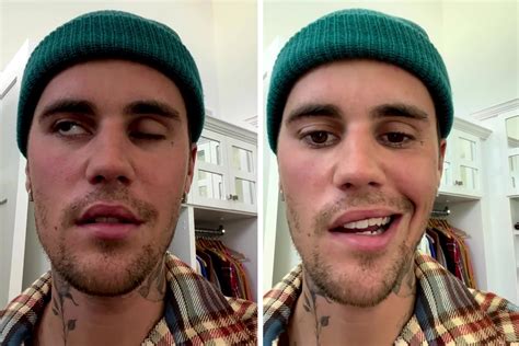 Justin Bieber Face Condition