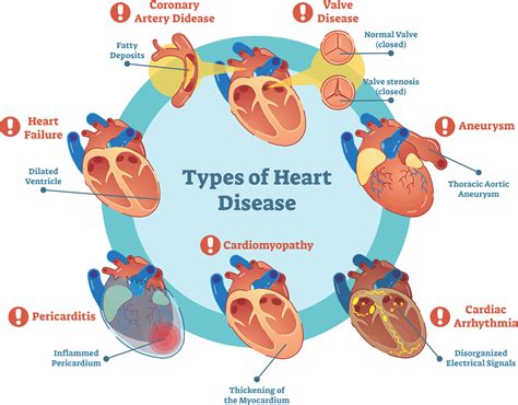 Know The Types Of Heart Disease Ztec100 Com