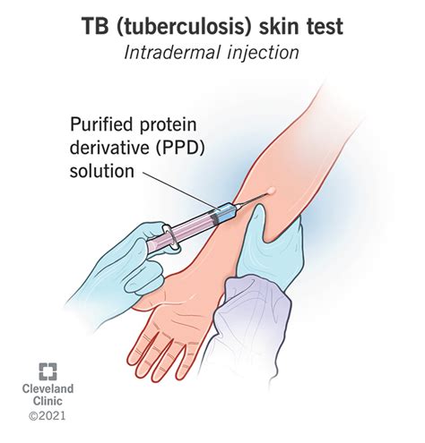 Lafene Tb Test