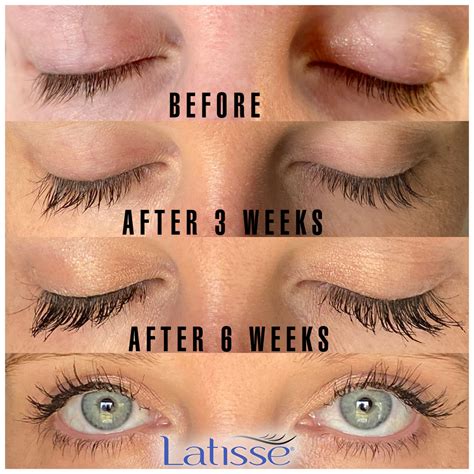 Latisse Before And After