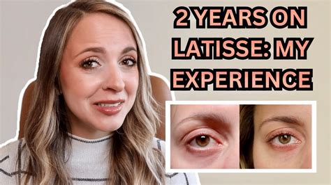 Latisse Eyelash Serum Side Effects