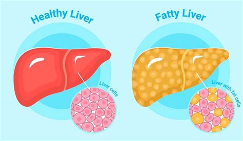 Magnesium For Fatty Liver