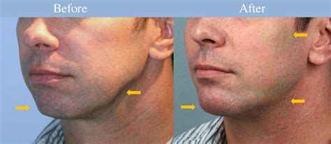 Male Plastic Surgery Procedures Business Insider