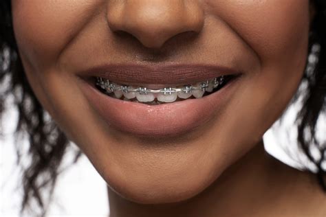 Medicaid Orthodontic Braces